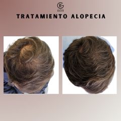 Alopecia - Clínica Dra. Kelly Gulfo