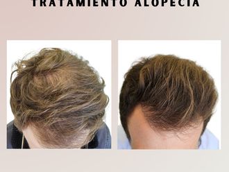 Alopecia - 865811