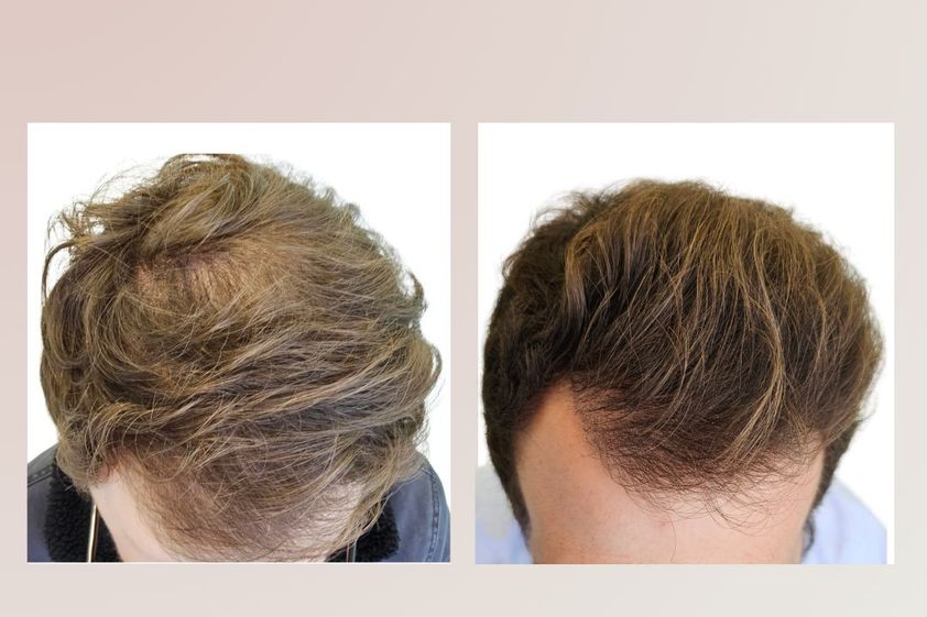Alopecia antes y después - 865811