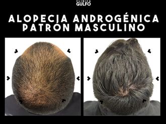 Alopecia antes y después - 866225