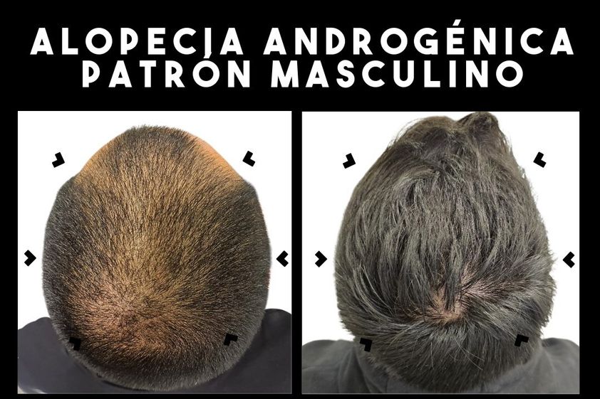 Alopecia antes y después - 866225