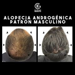 Alopecia - Clínica Dra. Kelly Gulfo