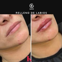 Aumento de labios - Clínica Dra. Kelly Gulfo