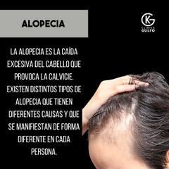 Alopecia, Clínica Dra. Kelly Gulfo