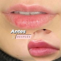 Aumento de labios - Dra. Carla Patínez