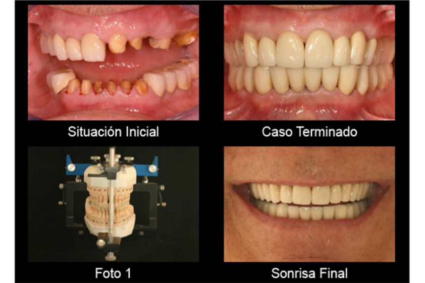 Endodoncia antes y después - 496170