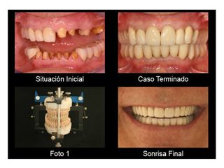 Reconstrucción dental