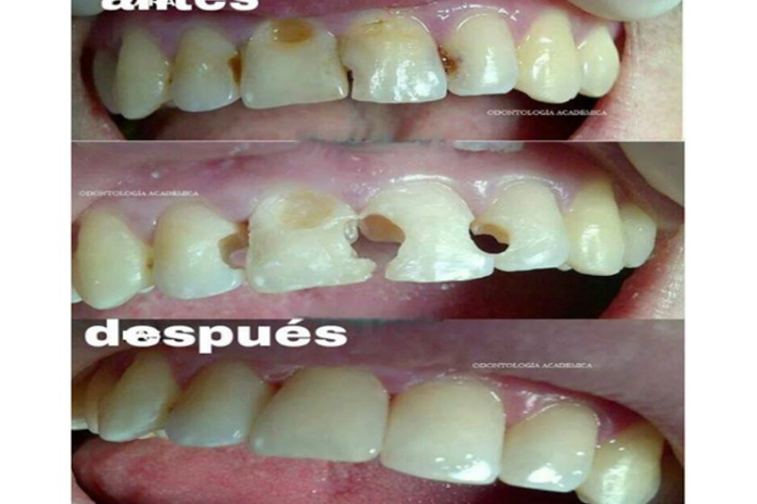 Endodoncia antes y después - 496172