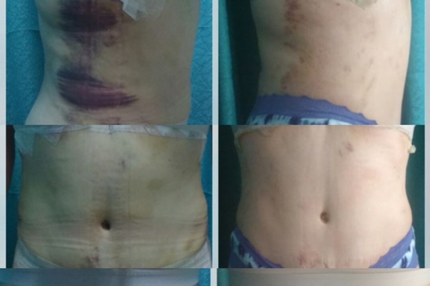 Drenaje linfático antes y después - 603851