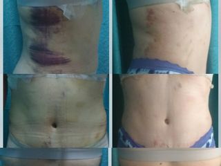 antes y después solo 5 sesiones de post operatorio (mitad del tratamiento) 