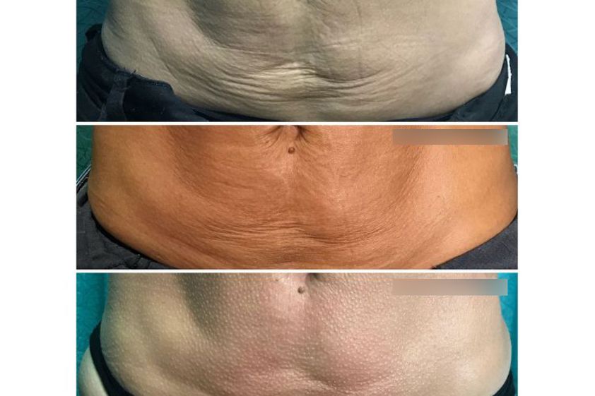 Lipoláser antes y después - 738912
