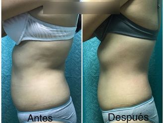 Radiofrecuencia antes y después - 738913