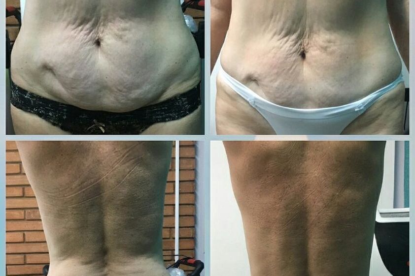 Drenaje linfático antes y después - 738919