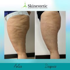 Tratamiento celulitis - Skinestetic