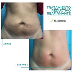 Radiofrecuencia - Skinestetic