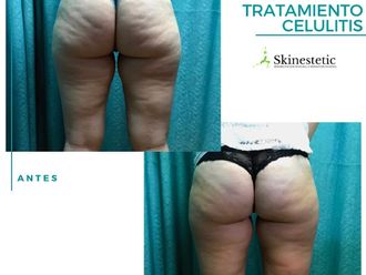 Tratamiento celulitis antes y después - 790065