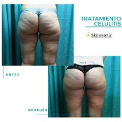 Tratamiento celulitis - Skinestetic