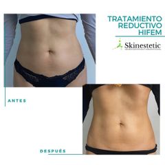 Masaje reductivo - Skinestetic