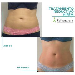 Tratamiento reductivo - Skinestetic