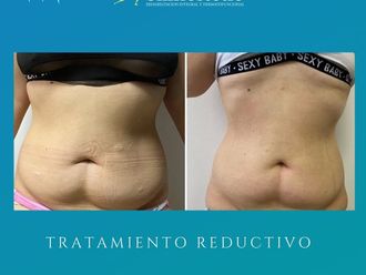 Radiofrecuencia antes y después - 841757