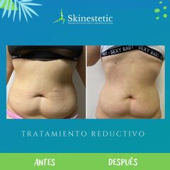 Radiofrecuencia - Skinestetic