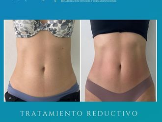 Cavitación antes y después - 841758