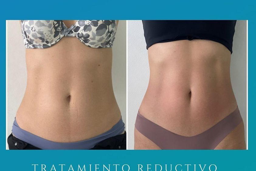 Cavitación antes y después - 841758