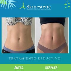Cavitación - Skinestetic