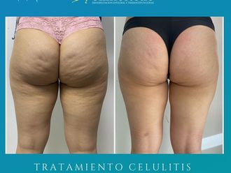 Radiofrecuencia antes y después - 841759