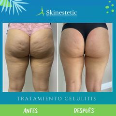 Radiofrecuencia - Skinestetic