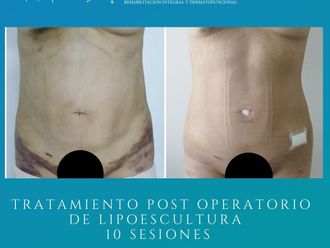 Drenaje linfático antes y después - 859918