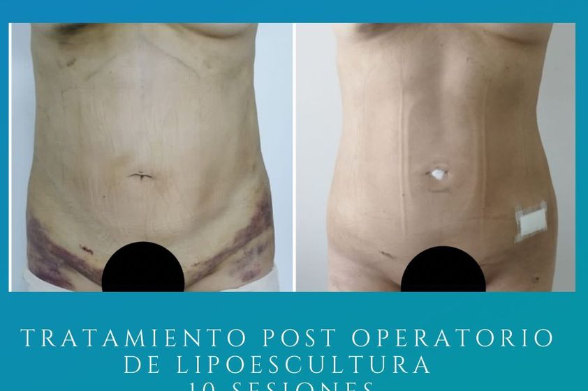 Drenaje linfático antes y después - 859918