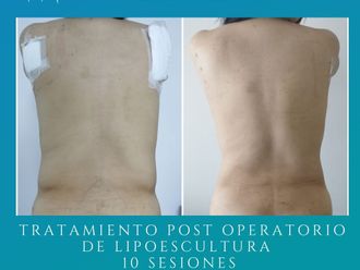 Drenaje linfático antes y después - 859919