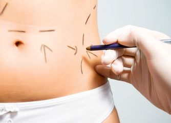 MELA ,(MINI EXTRACCION LIPIDICA AMBULATORIA )