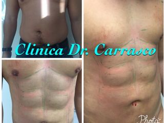 Marca tu abdomen 