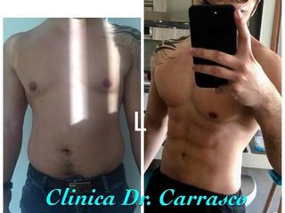Antes y despues de lipomarcacion