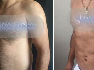 Antes y despues de lipomarcacion