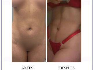 Lipo abdomen con anestesia local 
