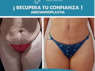 abdominoplastia