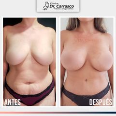 Abdominoplastia TULUA: Antes y Despues