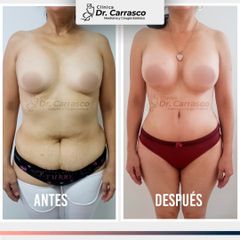 Abdominoplastia TULUA: Antes y Despues