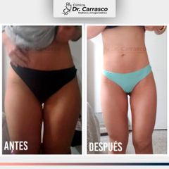 Lipoescultura de Muslo Interno