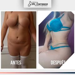 Lipoescultura Full: Antes y Despues