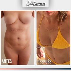 Lipoescultura de Abdomen