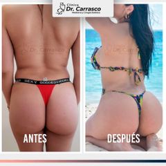Lipoescultura con Transferencia Glutea