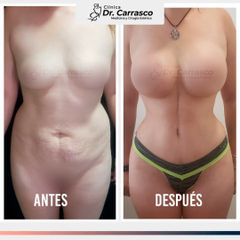 Abdominoplastia con Aumento Mamario - Dr. Freddy Carrasco