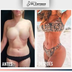 Lipoescultura HD de Abdomen y Cintura con Transferencia a glúteos - Dr. Freddy Carrasco