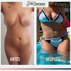 MELA RF de Abdomen Completo - Dr. Freddy Carrasco