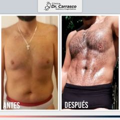 Marcación Abdominal - Dr. Freddy Carrasco