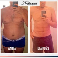 Ginecomastia + Marcación Abdominal - Dr. Freddy Carrasco